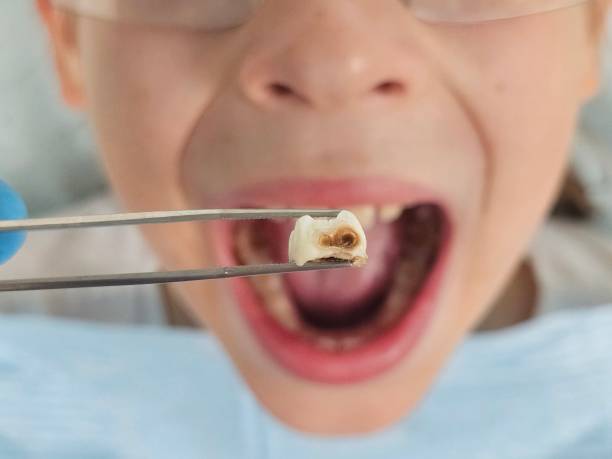 Best Knocked-Out Tooth Emergency  in Rawlins, WY